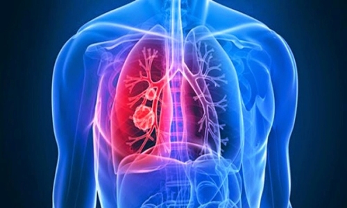 Thủ phạm của ung thư phổi từ thuốc lá
