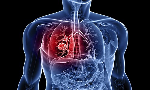 Ung thư phổi (ảnh minh họa)