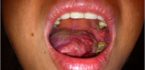 biểu hiện ung thư lưỡi giai đoạn cuối