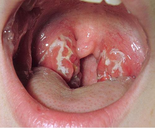 cách phòng chống ung thư vòm họng