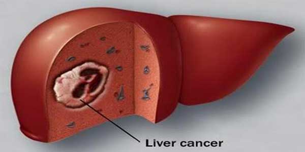 Cách phòng tránh ung thư gan