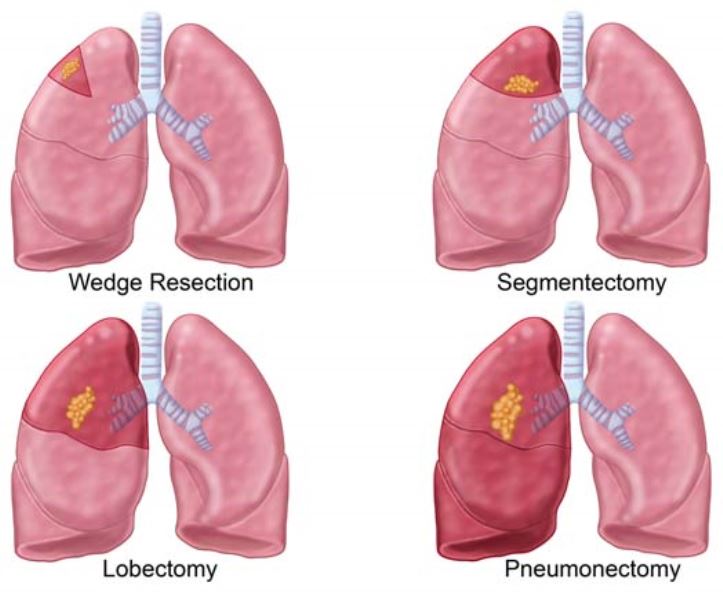 Chẩn đoán sớm ung thư phổi giúp ngăn ngừa ung thư phổi