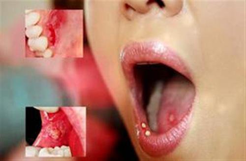 Dấu hiệu ung thư khoang miệng dễ bị nhầm lần với nhiệt miệng