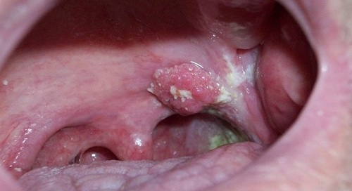 Dấu hiệu ung thư khoang miệng