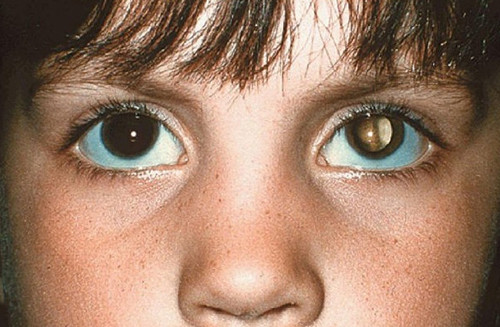 dấu hiệu ung thư mắt ở trẻ