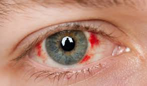 dấu hiệu ung thư mắt