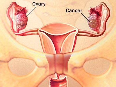 dấu hiệu cảnh báo ung thư phụ khoa ở phụ nữ