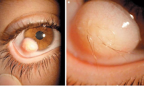 Khối u trong mắt chèn ép các bộ phận khác gây đau và giảm thị lực