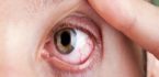 lầm tưởng ung thư mắt với viêm mắt
