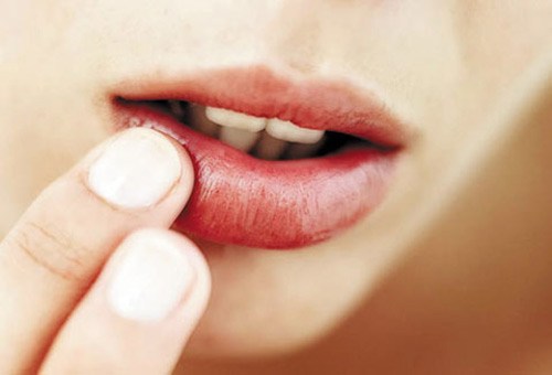 Viêm loét miệng gây đau nhức cho người bệnh.