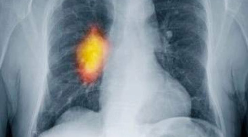 Nguyên nhân gây ung thư phổi không phải chỉ là thuốc lá