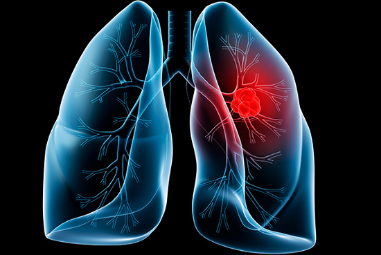 những triệu chứng ung thư phổi giai đoạn đầu