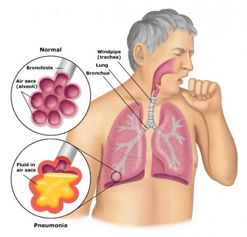 những triệu chứng ung thư phổi giai đoạn đầu
