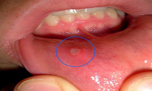 phân biệt ung thư lưỡi và nhiệt miệng