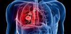 Phát hiện gen gây ung thư phổi?