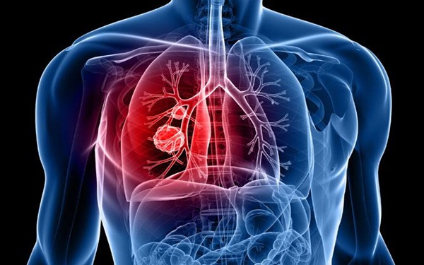 Phát hiện gen gây ung thư phổi