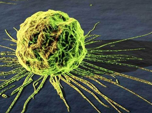 tế bào ung thư vú