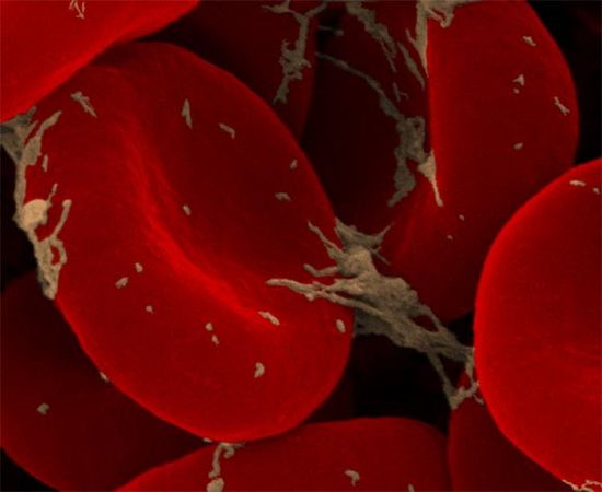 Tế bào ung thư máu - ảnh minh họa