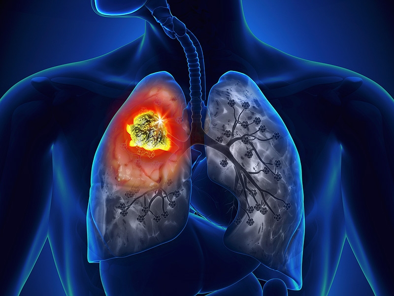 Tìm hiểu về bệnh ung thư phổi