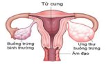 xét nghiệm tầm soát ung thư buồng trứng