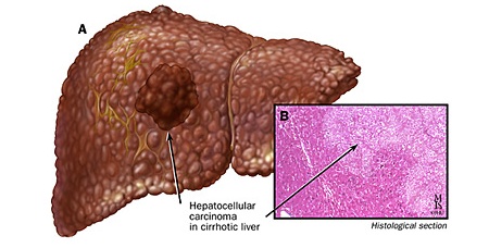 Hình ảnh phóng to của tế bào ung thư biểu mô gan