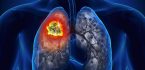 Nhanh chóng phát hiện ung thư phổi qua 8 dấu hiệu cơ bản