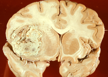 khối u não