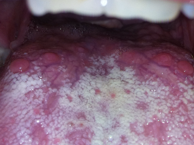 triệu chứng của bệnh ung thư lưỡi