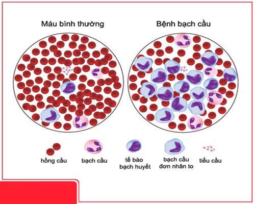 Ung thư máu là sự gia tăng đột biến tế bào bạch cầu trong cơ thể