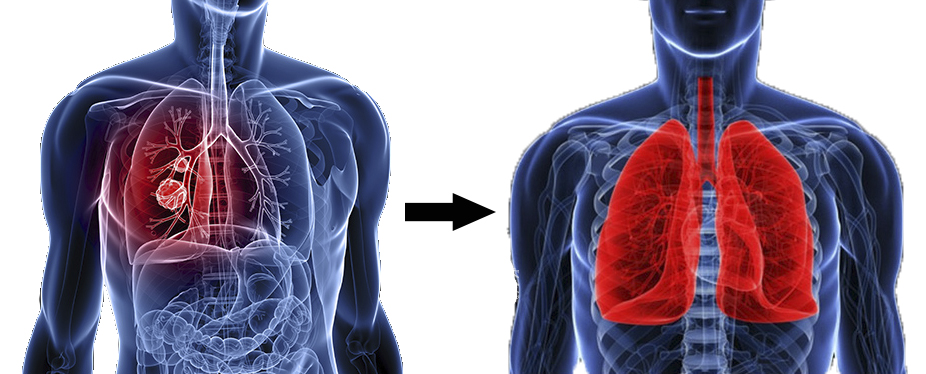 Bệnh ung thư phổi có thể được điều trị nếu người bệnh tuân thủ các phương pháp.