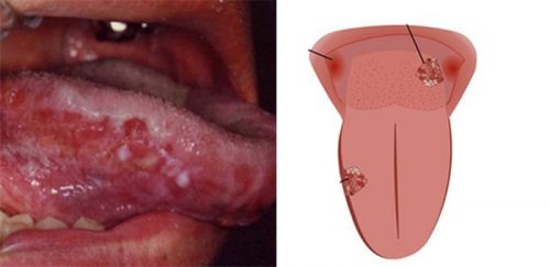 Các giai đoạn của ung thư lưỡi