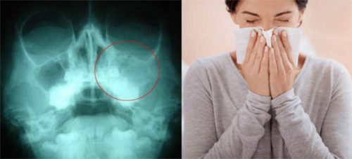 Cách chẩn đoán bệnh ung thư mũi