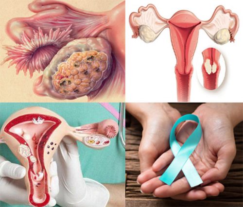 Cách chẩn đoán ung thư buồng trứng