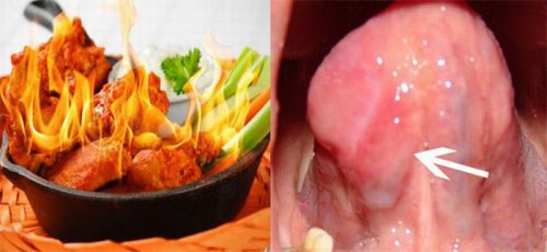 Người ung thư lưỡi kiêng ăn gì?
