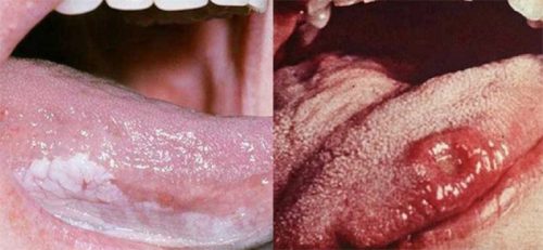 Triệu chứng ung thư lưỡi giai đoạn cuối