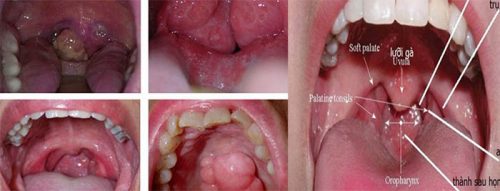 Biểu hiện của ung thư miệng giai đoạn cuối