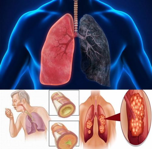 Các dấu hiệu ung thư phổi giai đoạn đầu