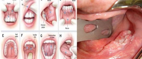 Các giai đoạn phát triển ung thư miệng