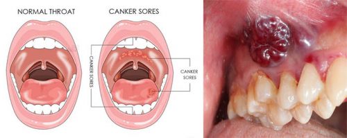 Cách điều trị ung thư miệng