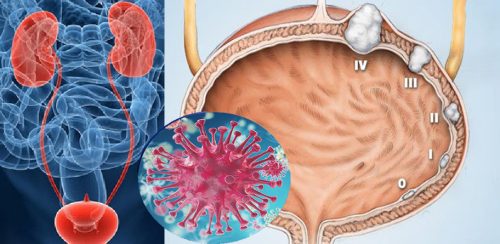 Chăm sóc người bị ung thư bàng quang giai đoạn cuối