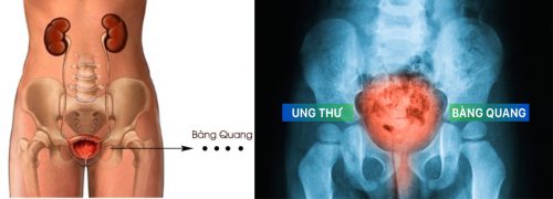 Đối tượng dễ có nguy cơ bị ung thư bàng quang