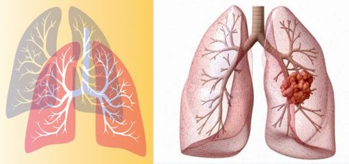 Nguyên tắc phòng ngừa ung thư phổi