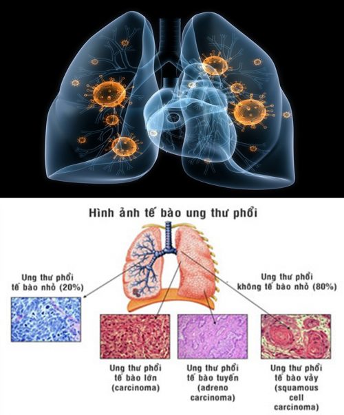 Những giai đoạn ung thư phổi ở tế bào nhỏ