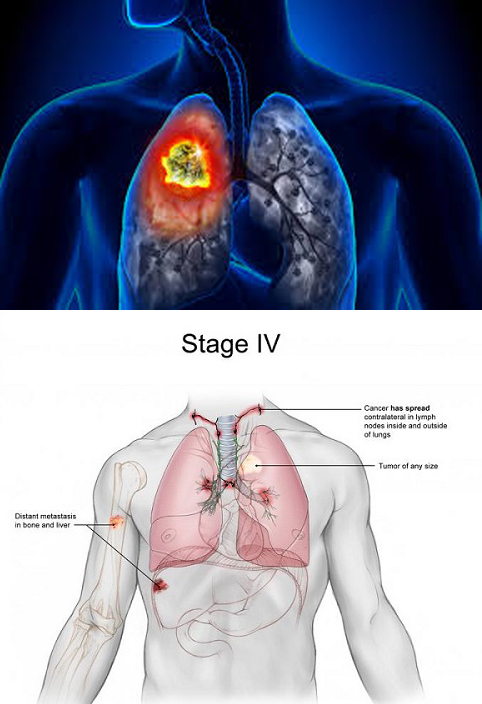 Những triệu chứng ung thư phổi giai đoạn cuối