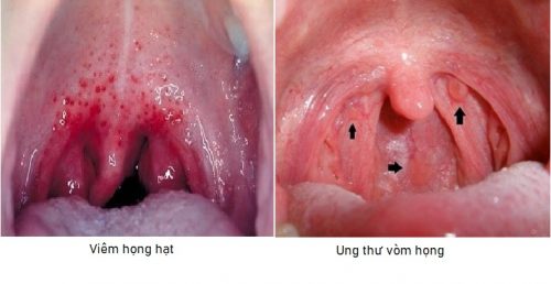 Phân biệt ung thư vòm họng và viêm họng hạt