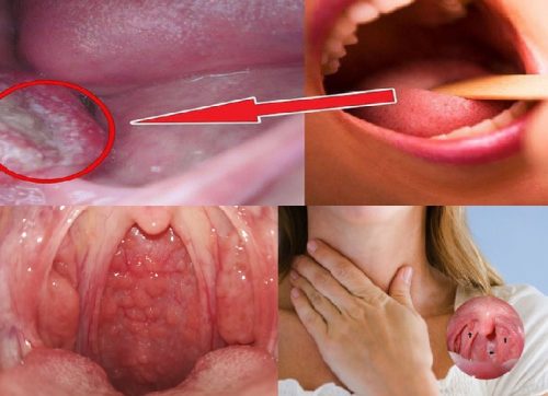 Phương pháp chẩn đoán ung thư vòm họng
