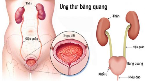 Ung thư bàng quang là gì?