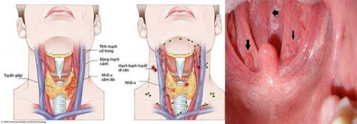 Ung thư biểu mô vòm họng