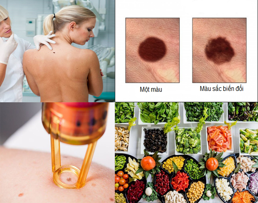 Ung thư da với nguyên nhân triệu chứng và dấu hiệu bệnh ung thư da
