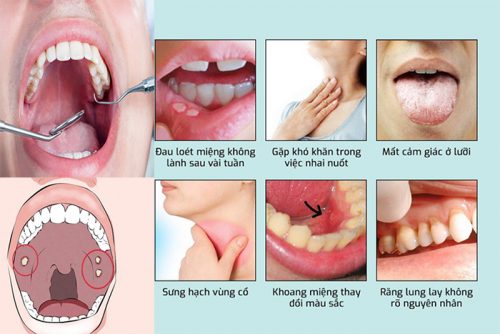 Ung thư miệng với dấu hiệu nguyên nhân và các giai đoạn K miệng